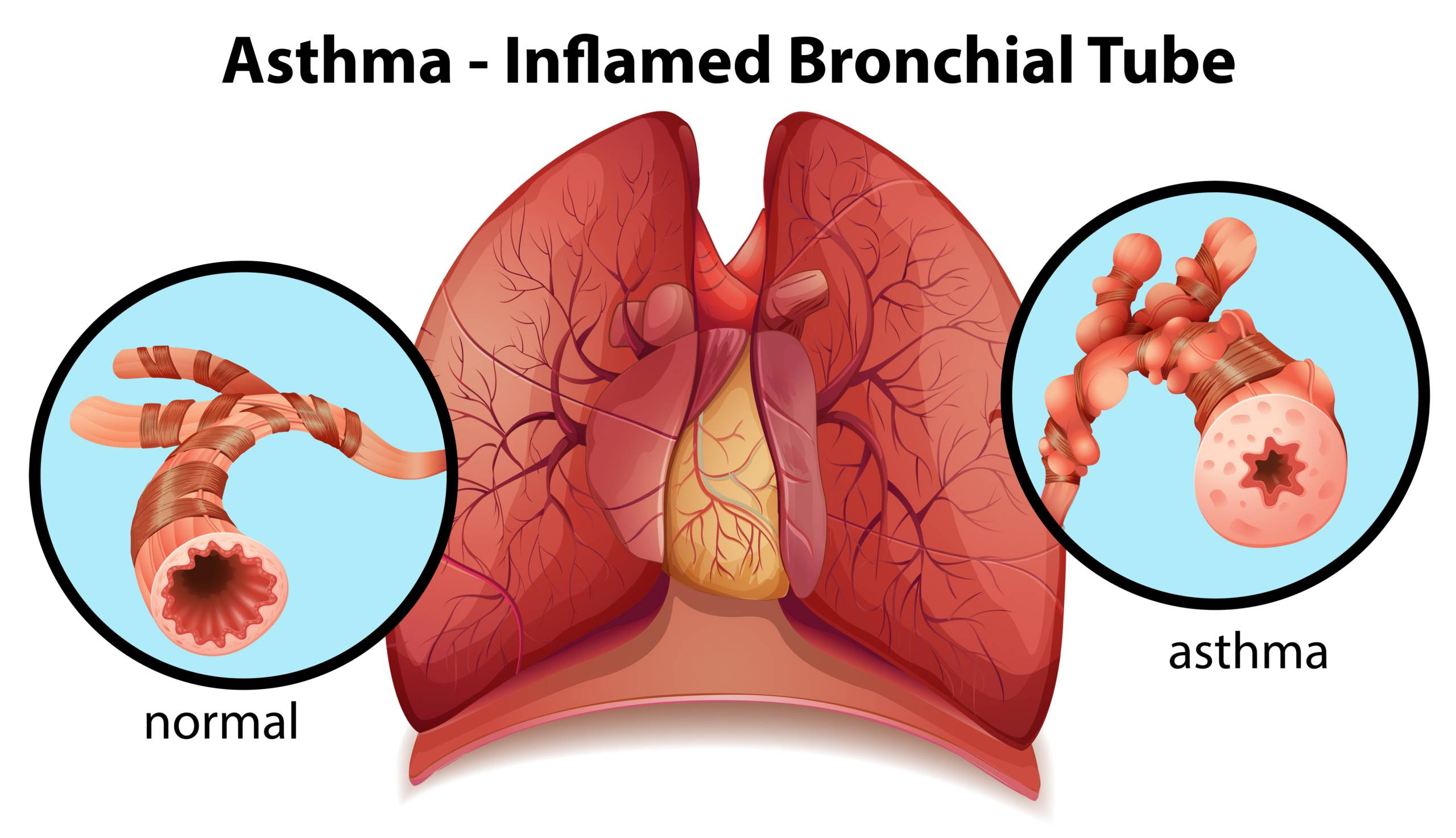 An image of an asthma-inflamed bronchial tube on a white background when using cannabis for asthma. SpeedGreens.